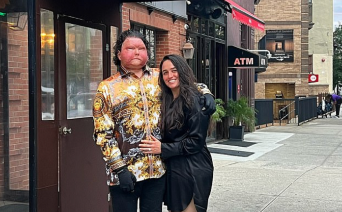 Face transplant survivor
