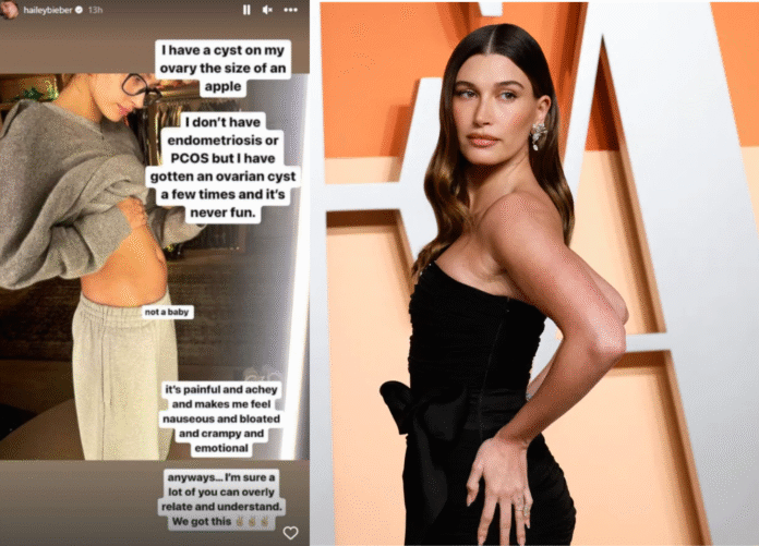 Hailey Bieber Ovarian Cysts